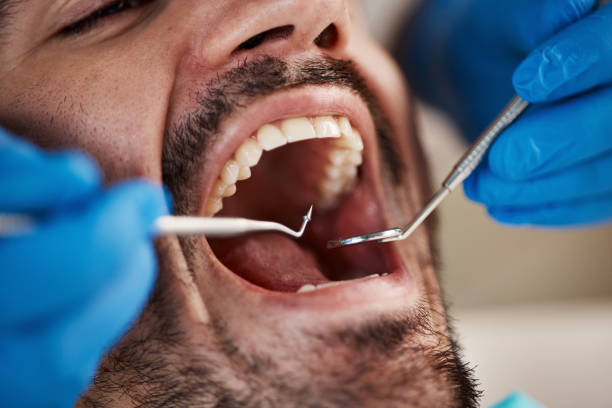 Best Emergency Root Canal Treatment in Harbour Heights, FL