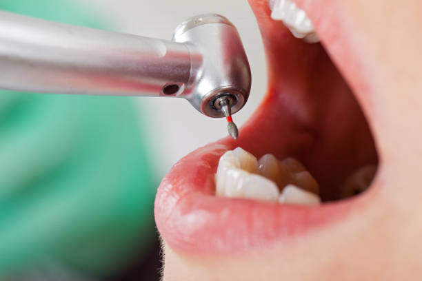 Best Emergency Dental Surgery in Harbour Heights, FL